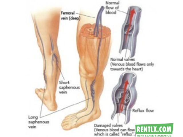 VEIN CLINIC - Legs for Life